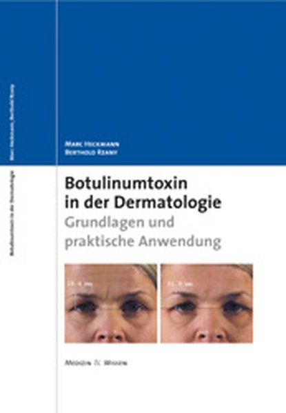 Heckmann, Marc und Berthold Rzany:  Botulinumtoxin in der Dermatologie : Grundlagen und praktische Anwendung. 